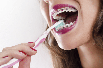 braces and cavities Grosso Orthodontics