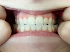 Virtualsmileassessment-400×300 Grosso orthodontics virtual smile assessment