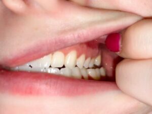 Virtualsmileassessment4-400×300 Grosso orthodontics virtual smile assessment