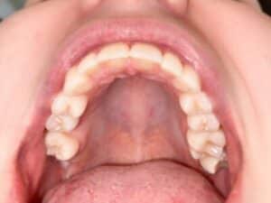 Virtualsmileassessment6-400×300 Virtual smile assessment grosso orthodontics
