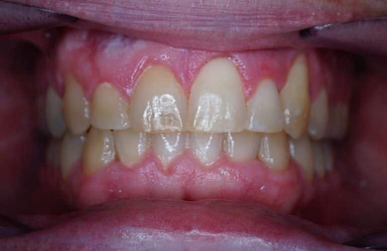 Results after braces teeth