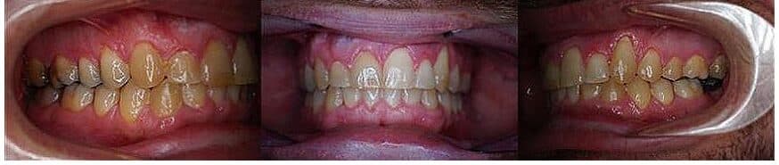After photo straight teeth results