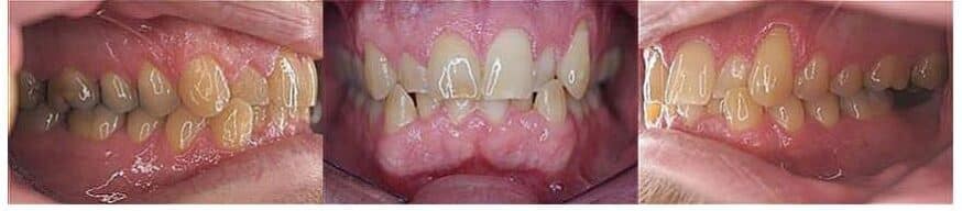 Before photo bite issues