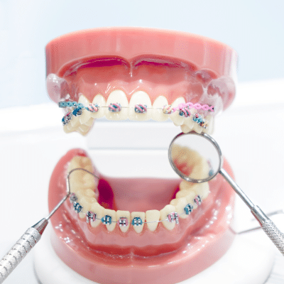 Orthodontic myths: separating fact from fiction 3 Plastic teeth opened up with dental instruments around, representing orthodontic myths